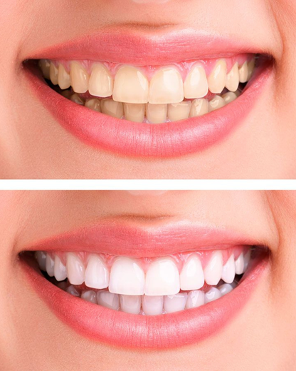 LÁPIZ BLANQUEADOR DENTAL Jaysuing